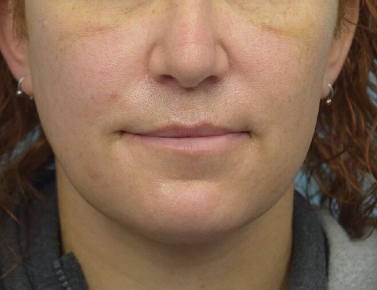 Renuvion Skin Tightening Before & After Image