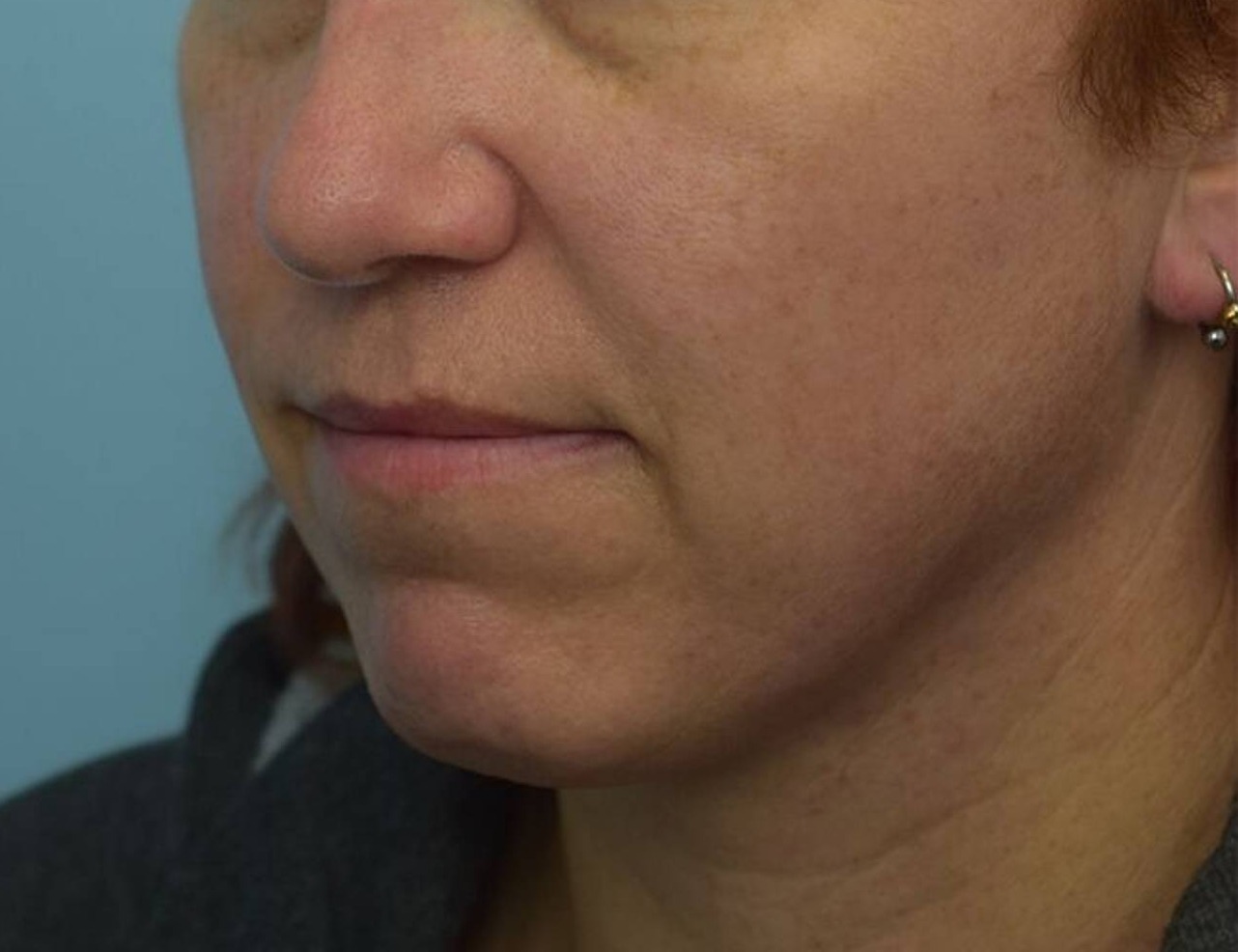 Renuvion Skin Tightening Before & After Image