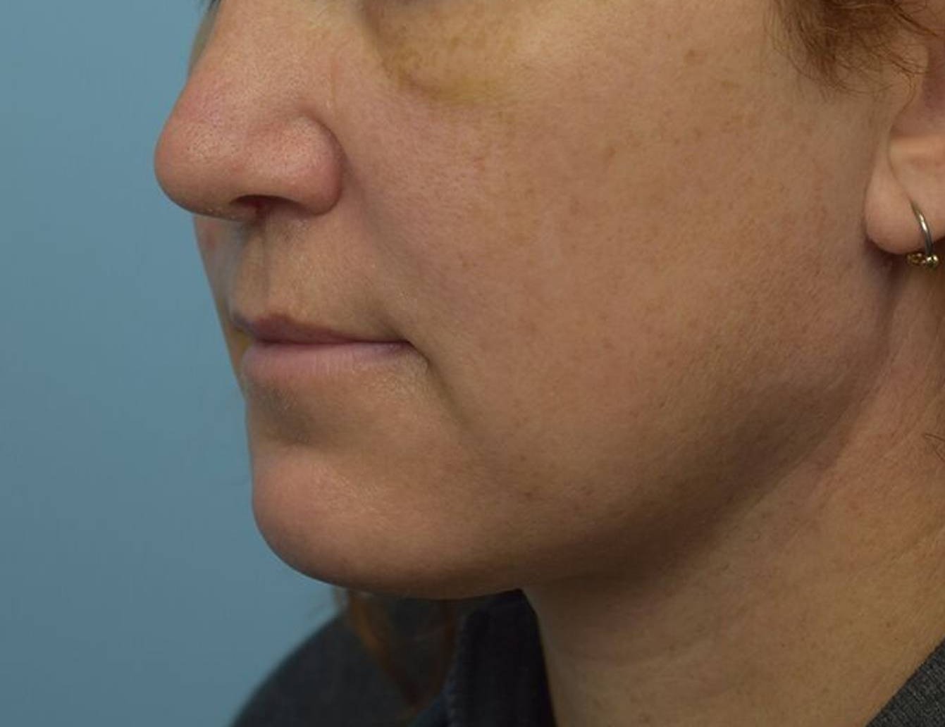 Renuvion Skin Tightening Before & After Image