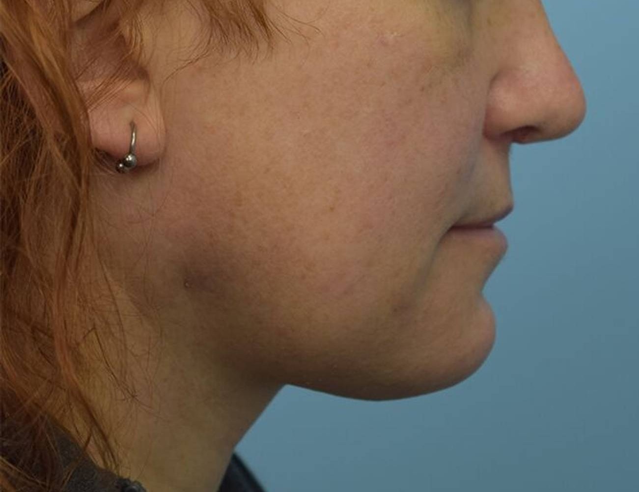 Renuvion Skin Tightening Before & After Image