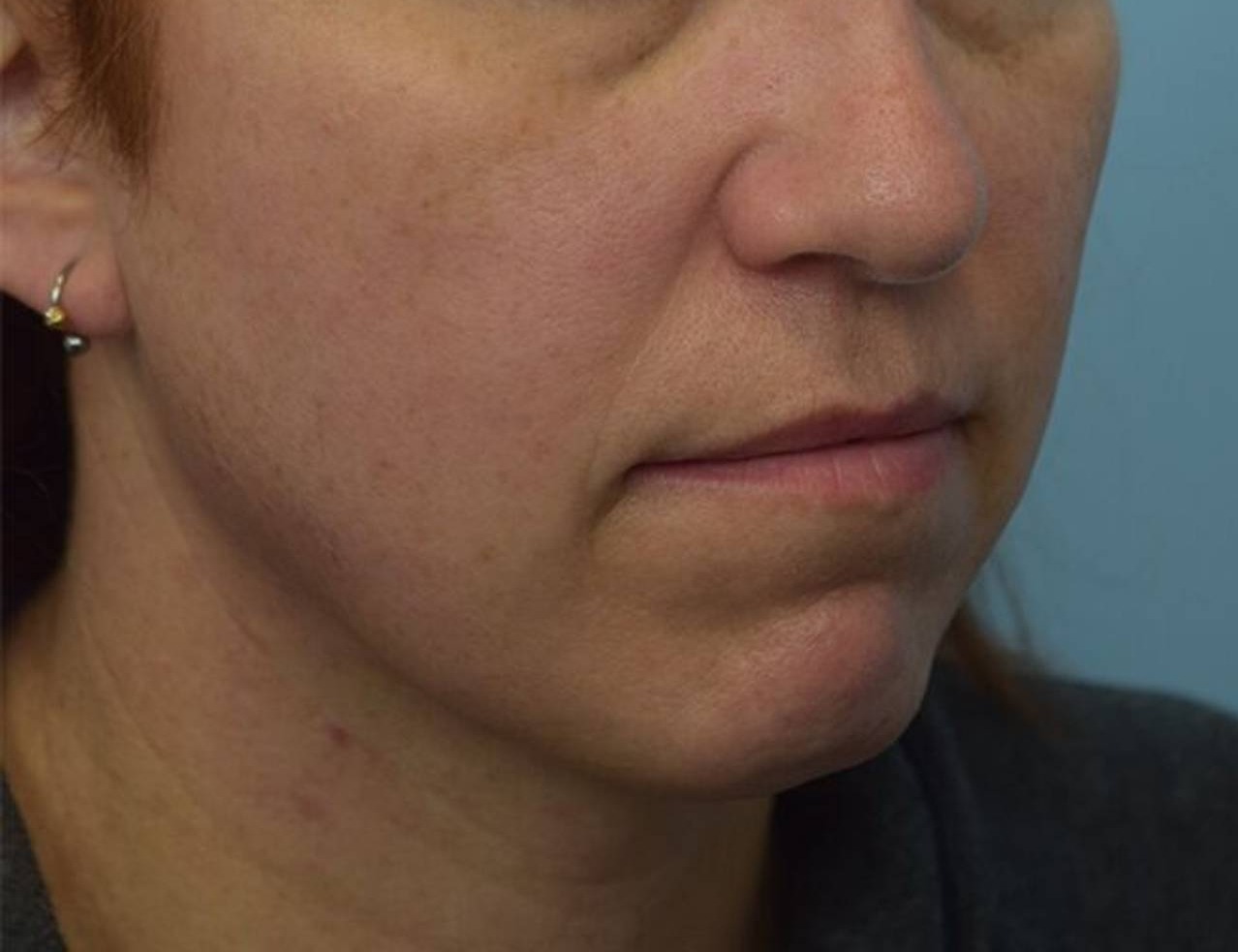 Renuvion Skin Tightening Before & After Image