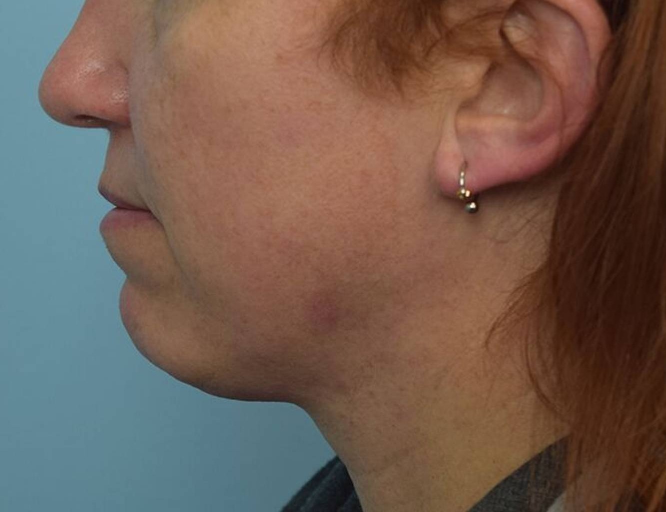 Renuvion Skin Tightening Before & After Image