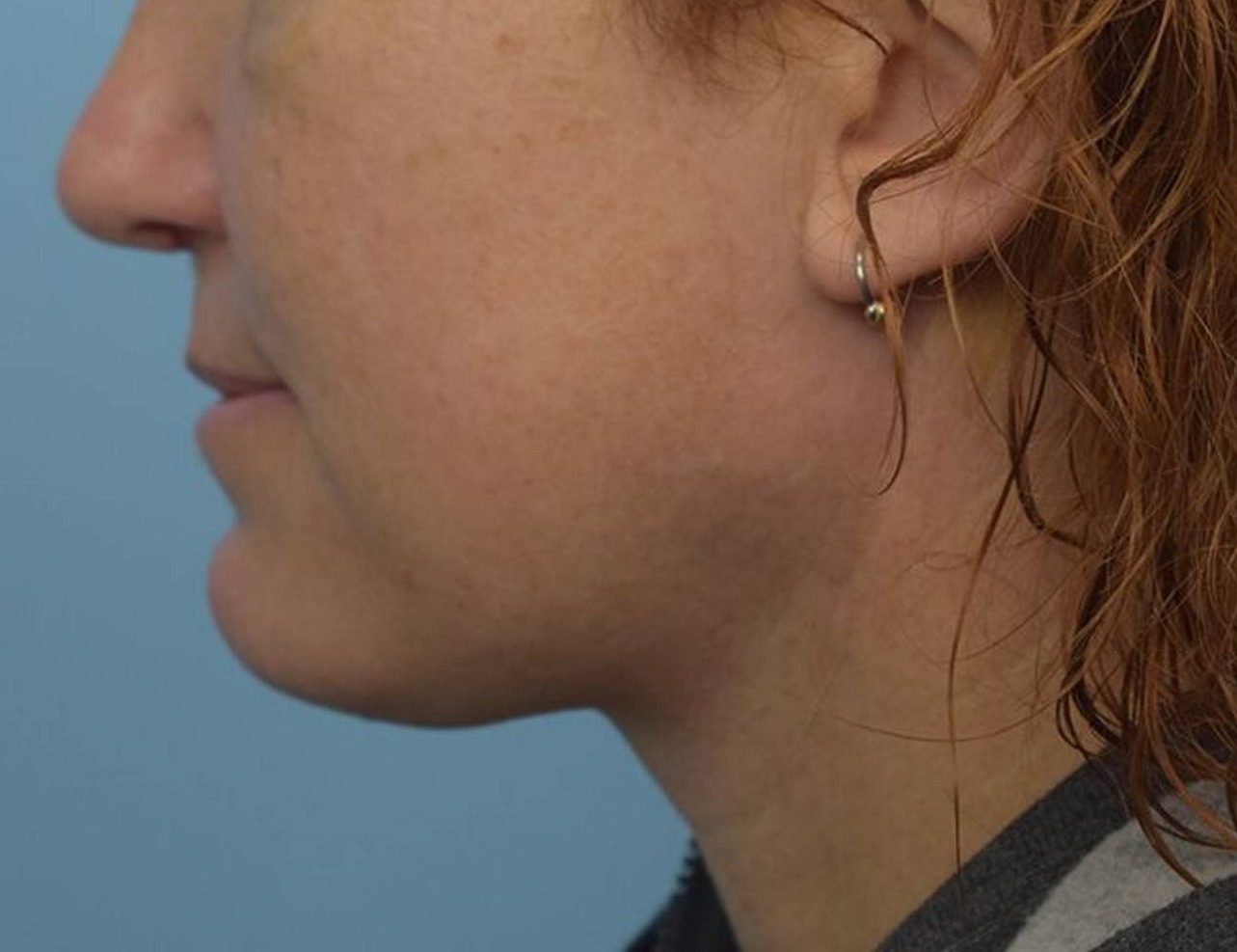 Renuvion Skin Tightening Before & After Image