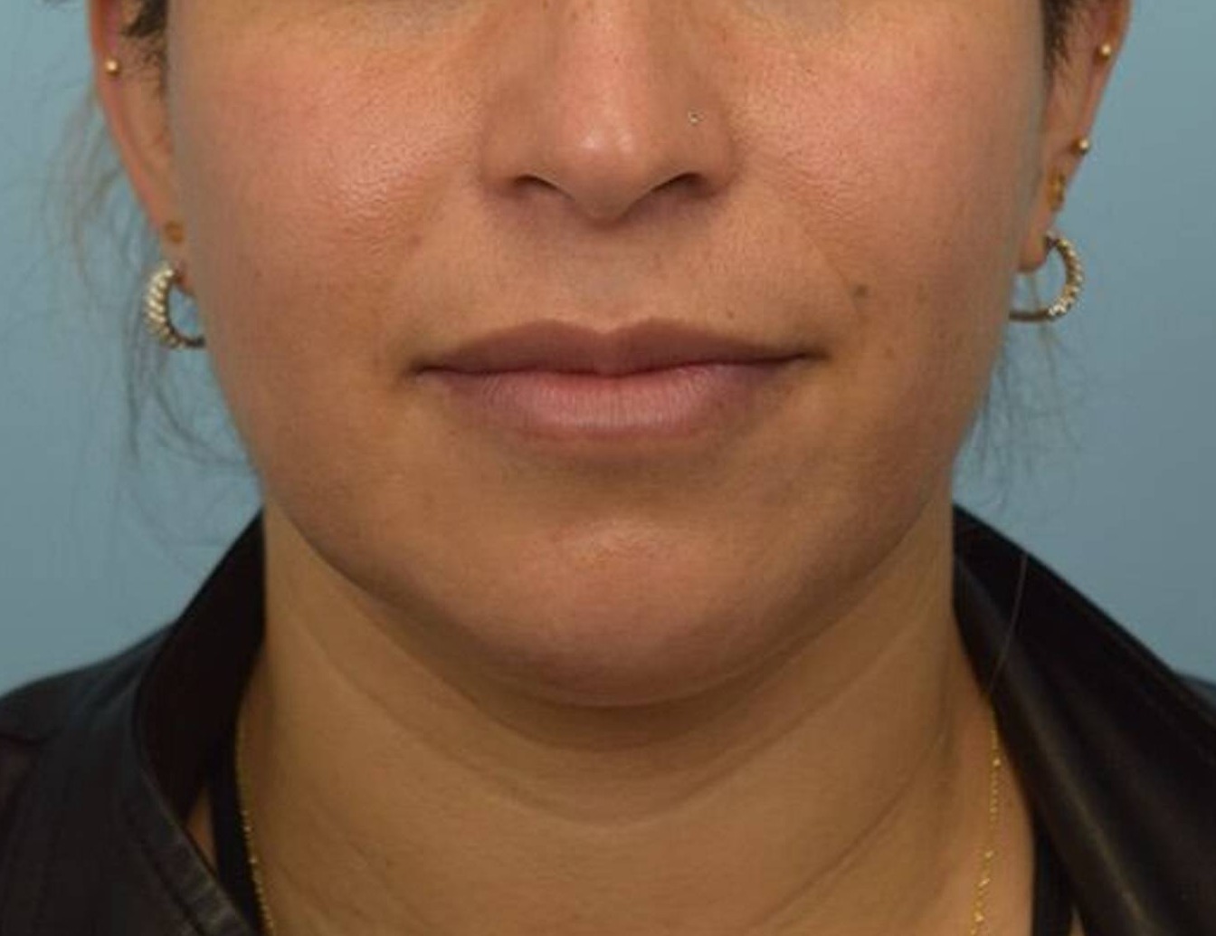 Renuvion Skin Tightening Before & After Image