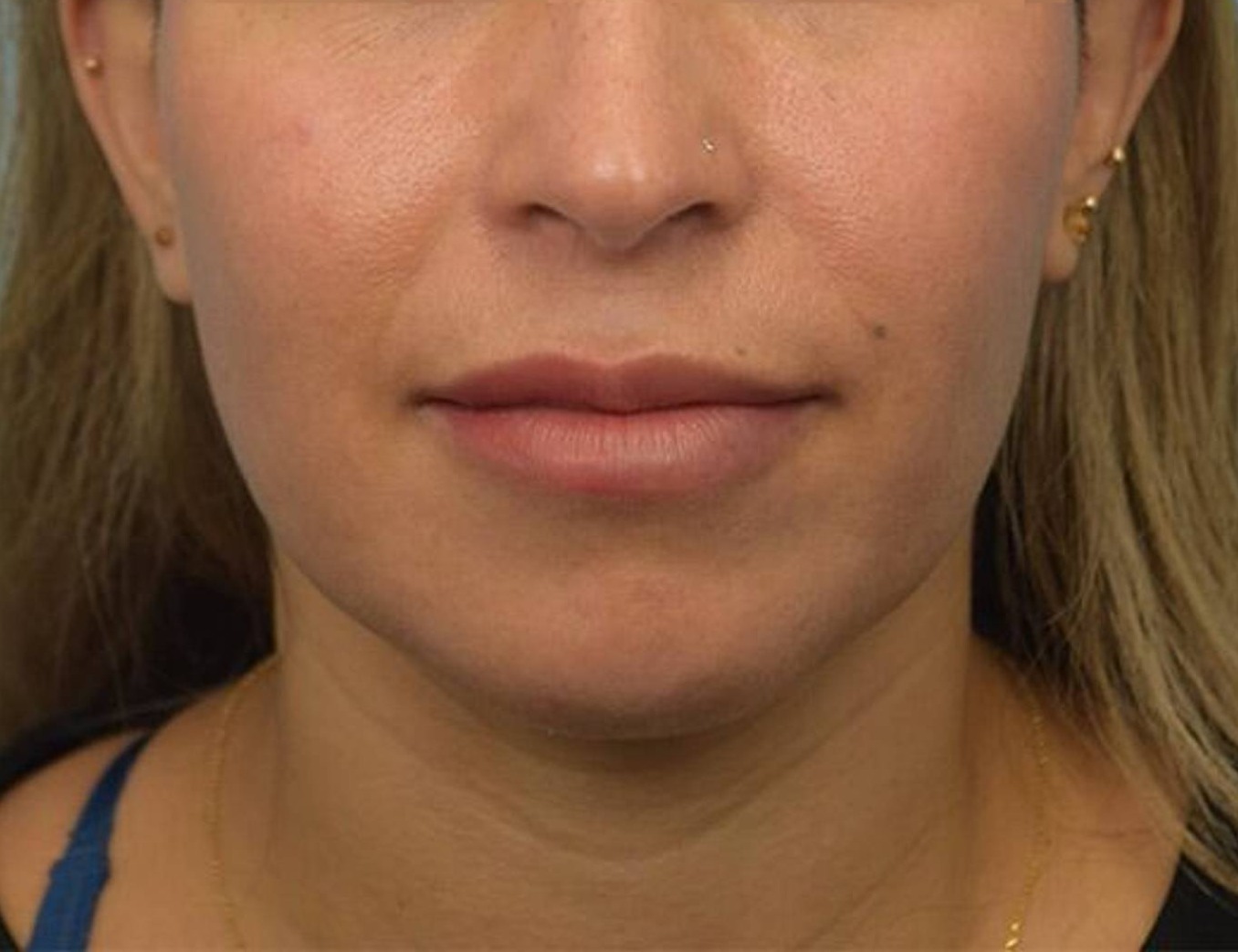 Renuvion Skin Tightening Before & After Image