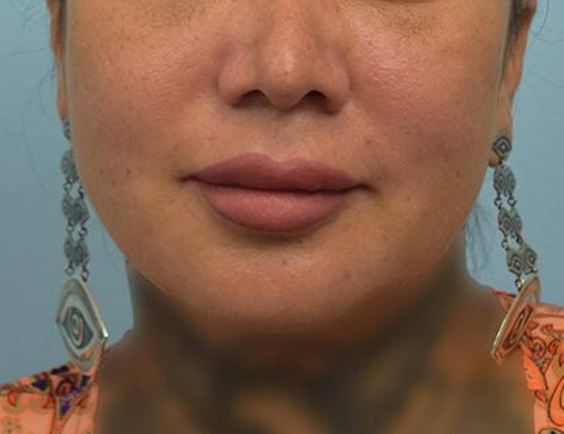 Renuvion Skin Tightening Before & After Image