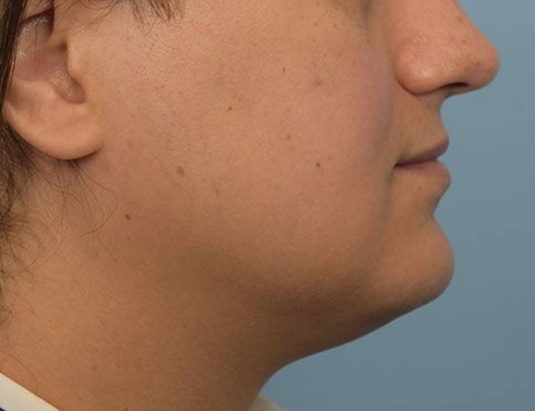 Renuvion Skin Tightening Before & After Image