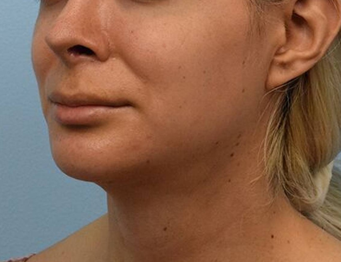 Renuvion Skin Tightening Before & After Image