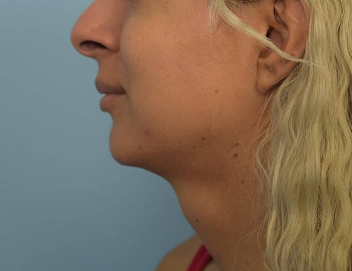 Renuvion Skin Tightening Before & After Image