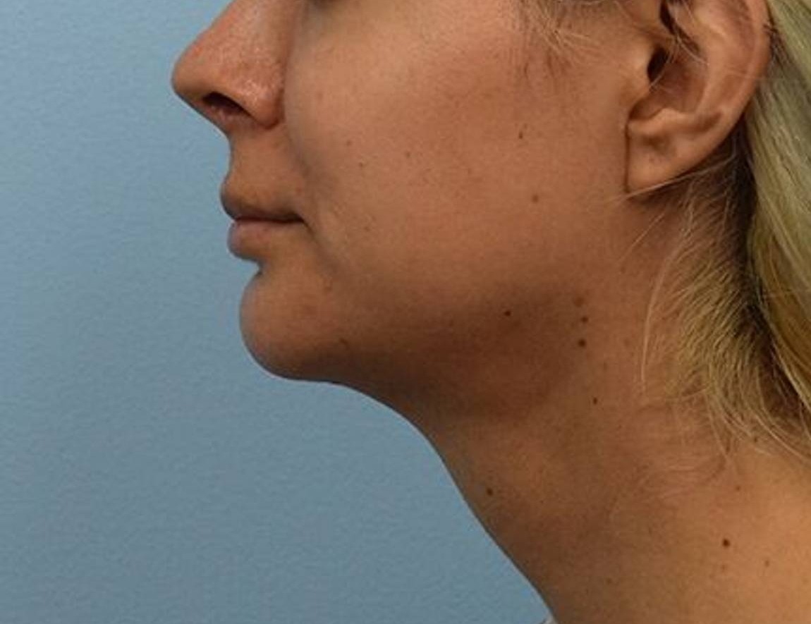 Renuvion Skin Tightening Before & After Image