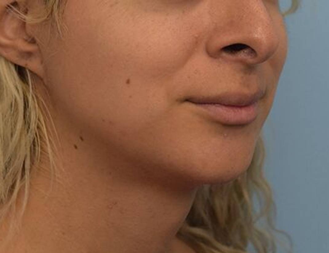 Renuvion Skin Tightening Before & After Image