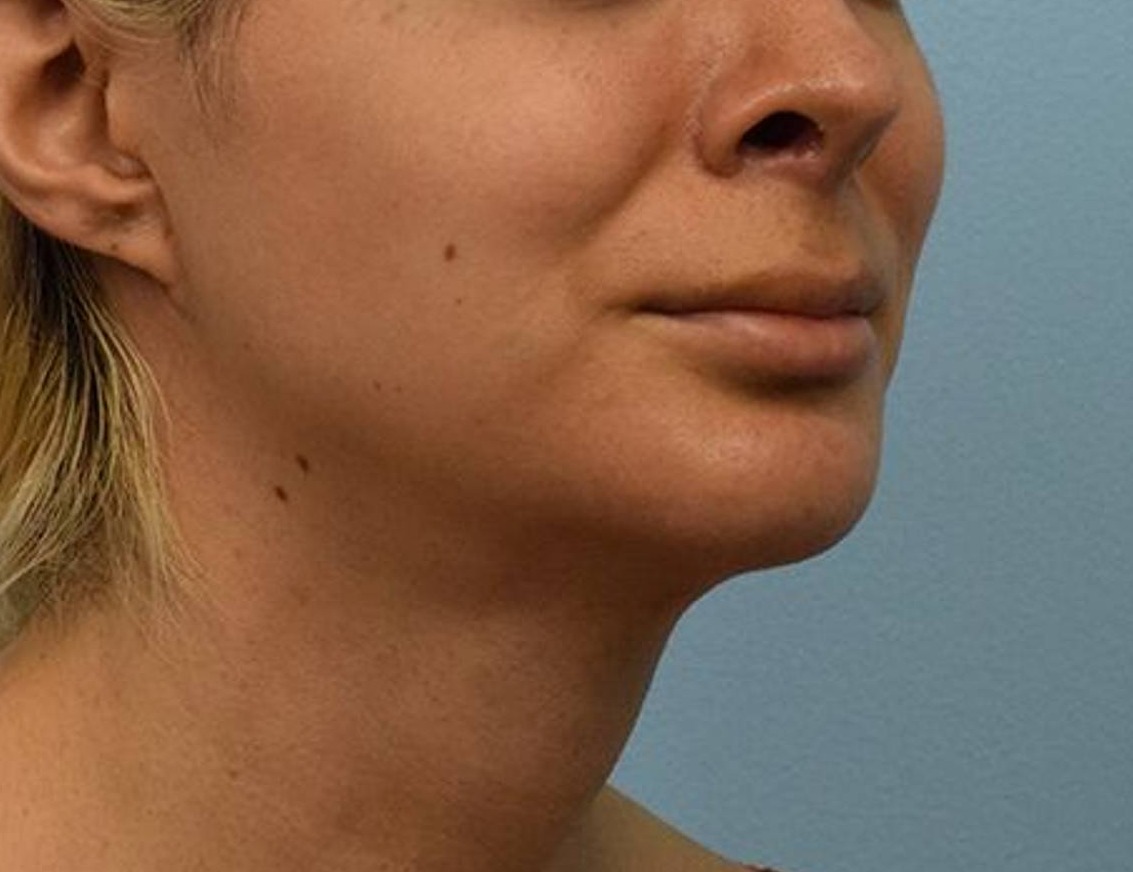 Renuvion Skin Tightening Before & After Image