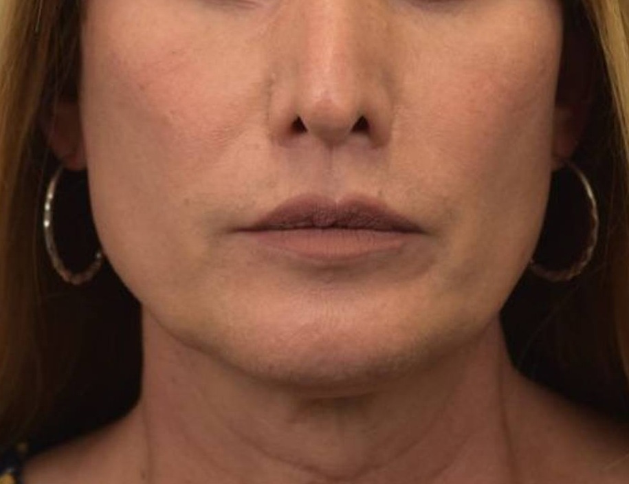 Renuvion Skin Tightening Before & After Image