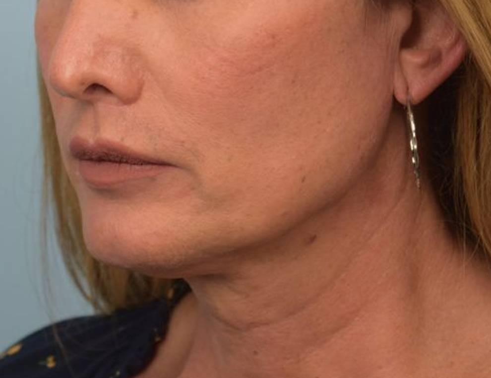 Renuvion Skin Tightening Before & After Image