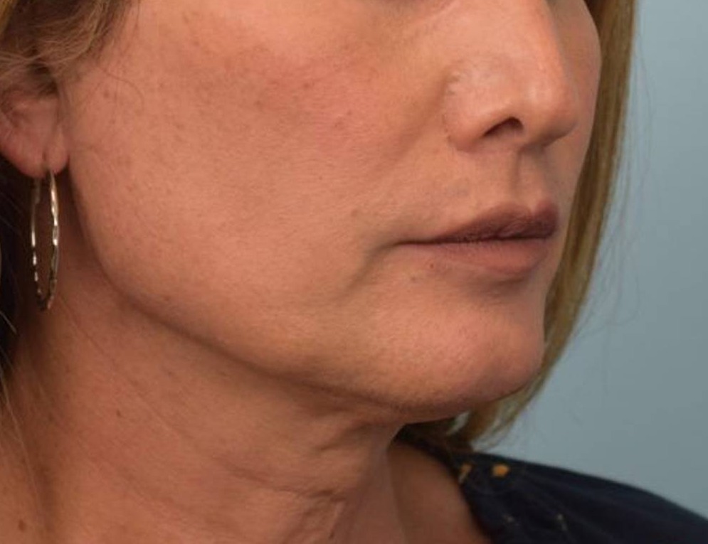 Renuvion Skin Tightening Before & After Image