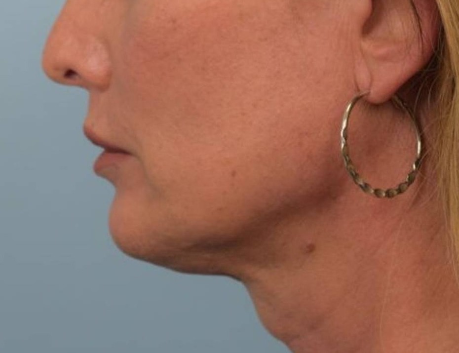 Renuvion Skin Tightening Before & After Image