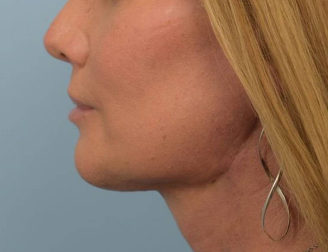 Renuvion Skin Tightening Before & After Image