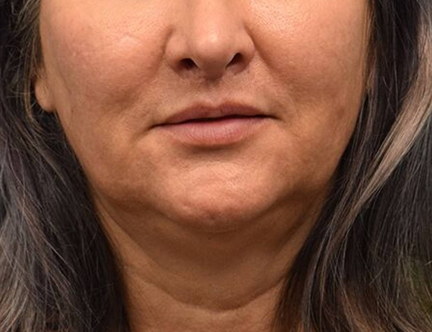 Renuvion Skin Tightening Before & After Image