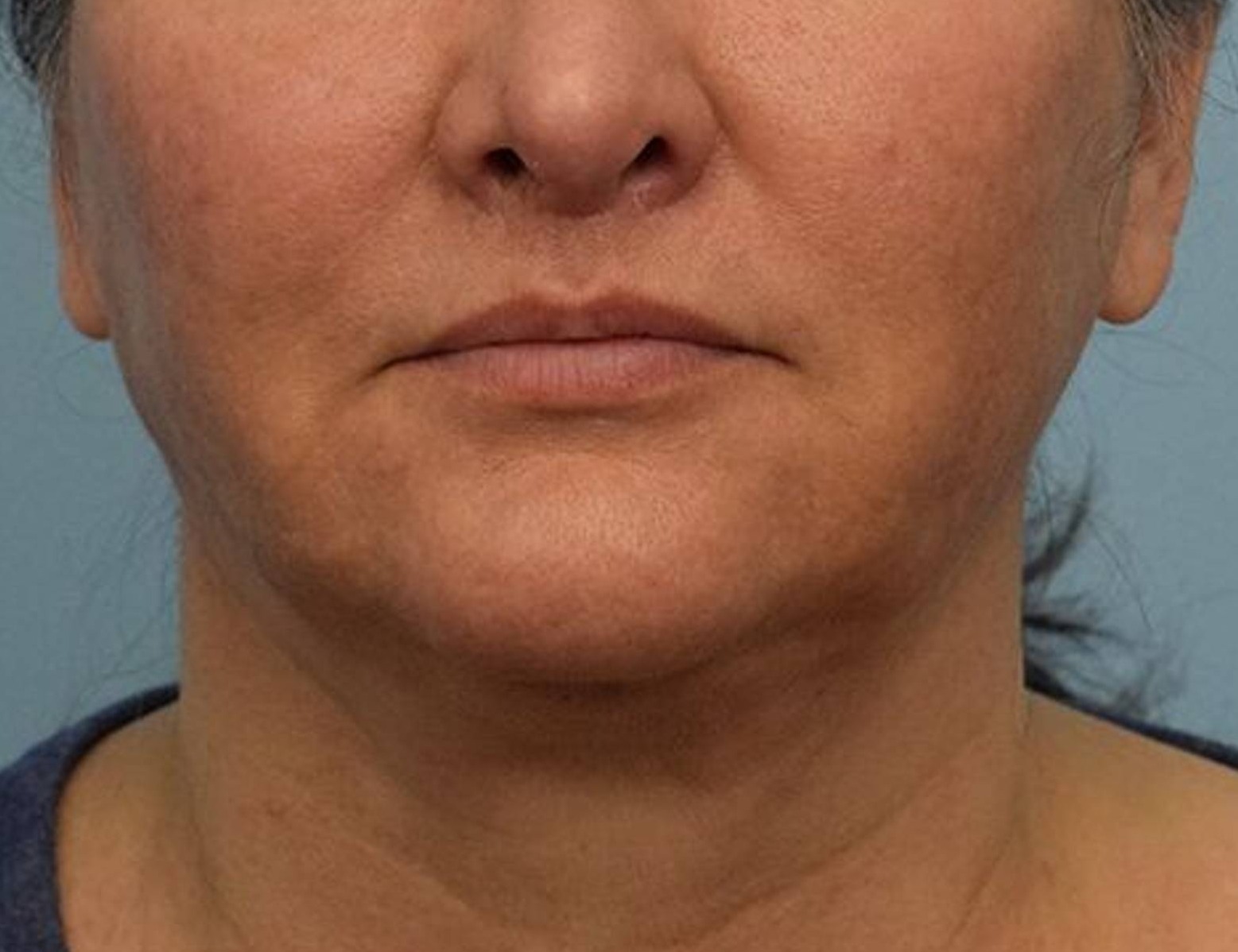 Renuvion Skin Tightening Before & After Image