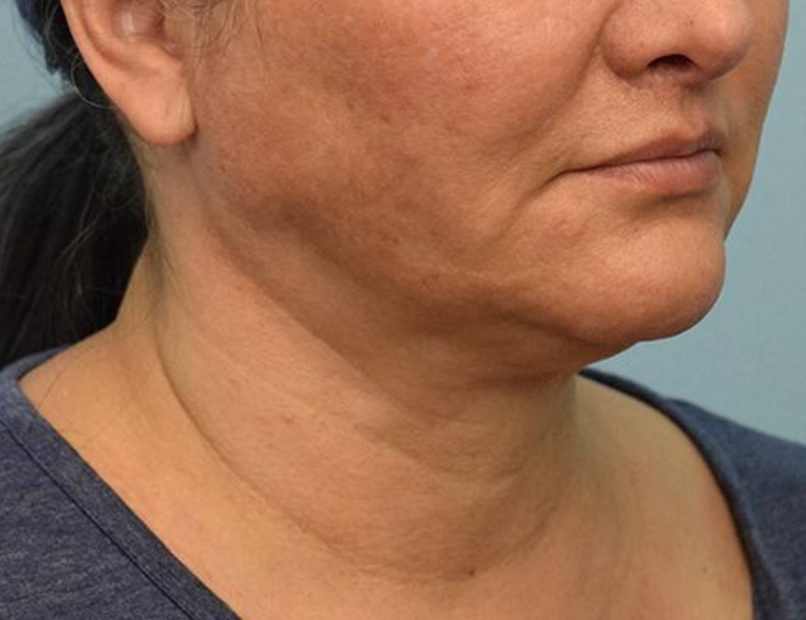 Renuvion Skin Tightening Before & After Image