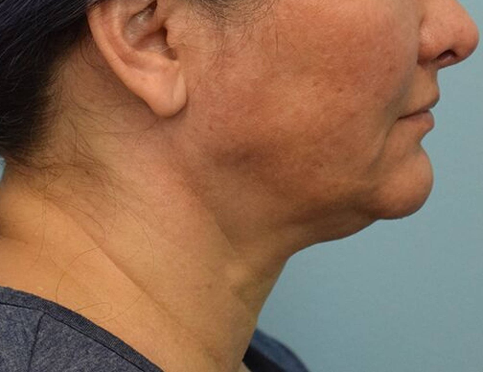 Renuvion Skin Tightening Before & After Image