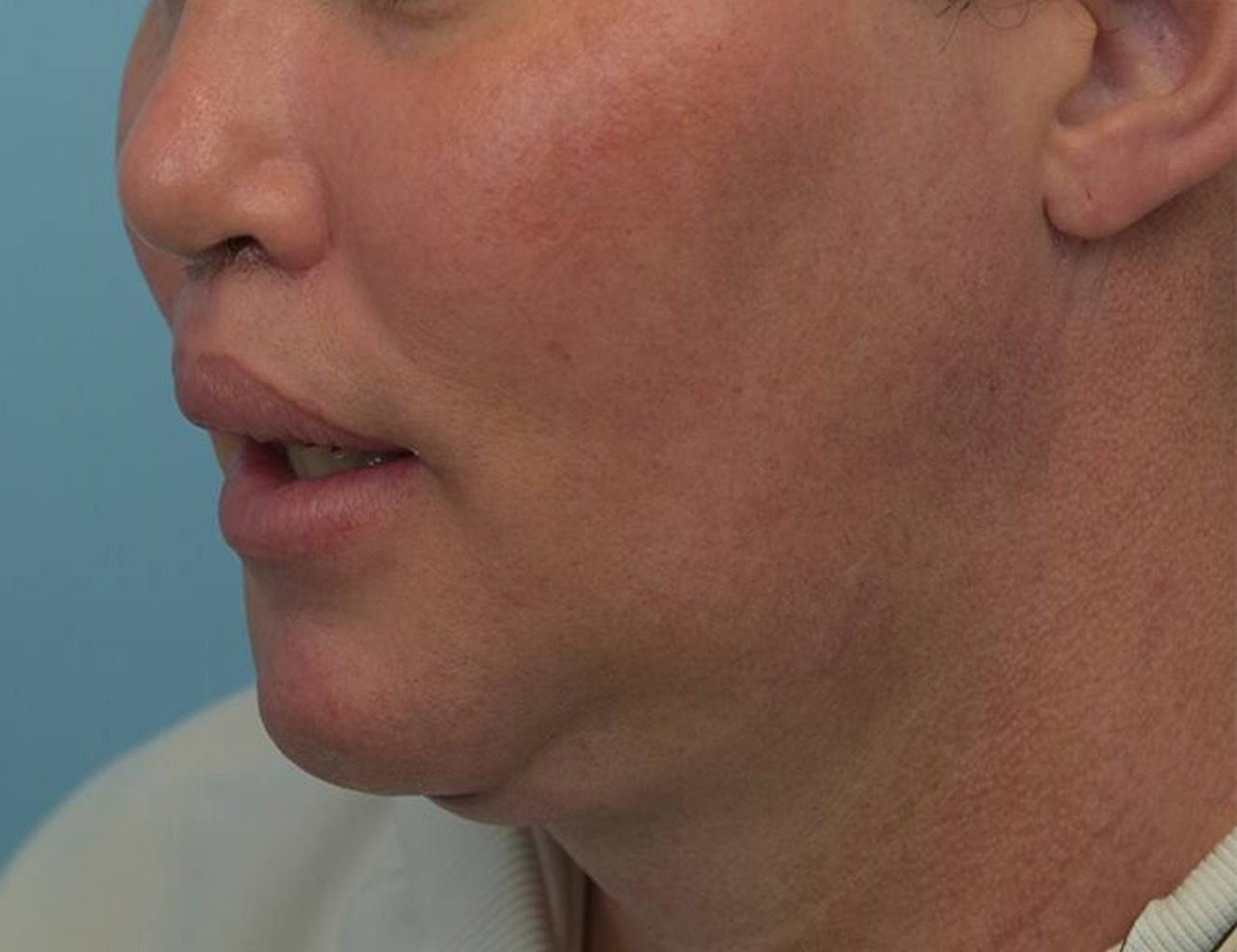 Renuvion Skin Tightening Before & After Image