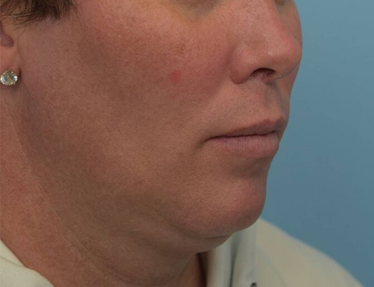 Renuvion Skin Tightening Before & After Image