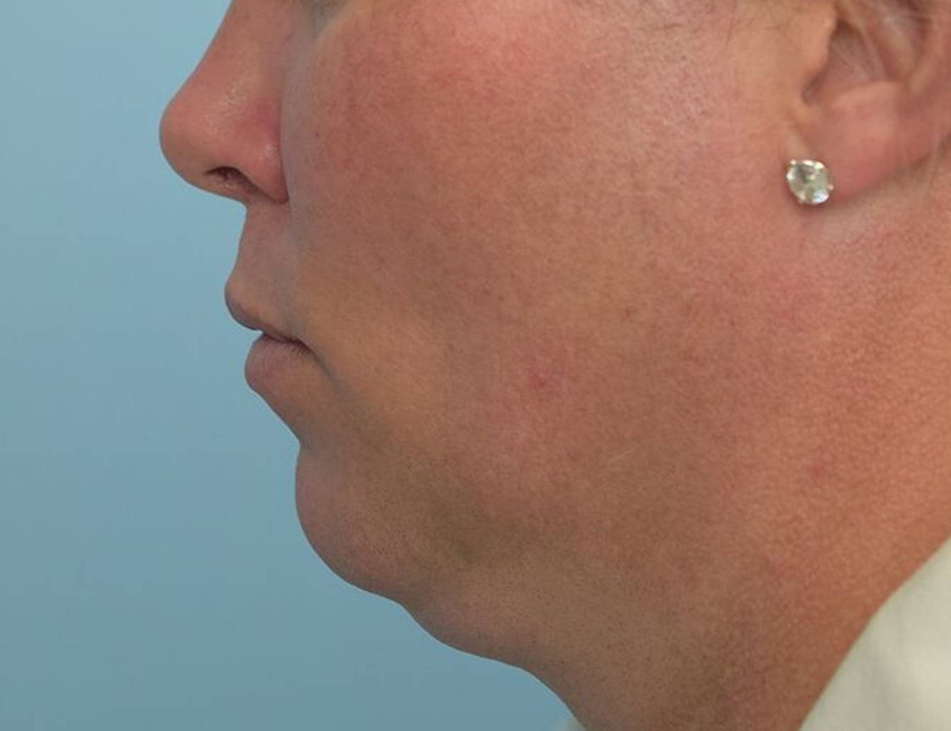 Renuvion Skin Tightening Before & After Image