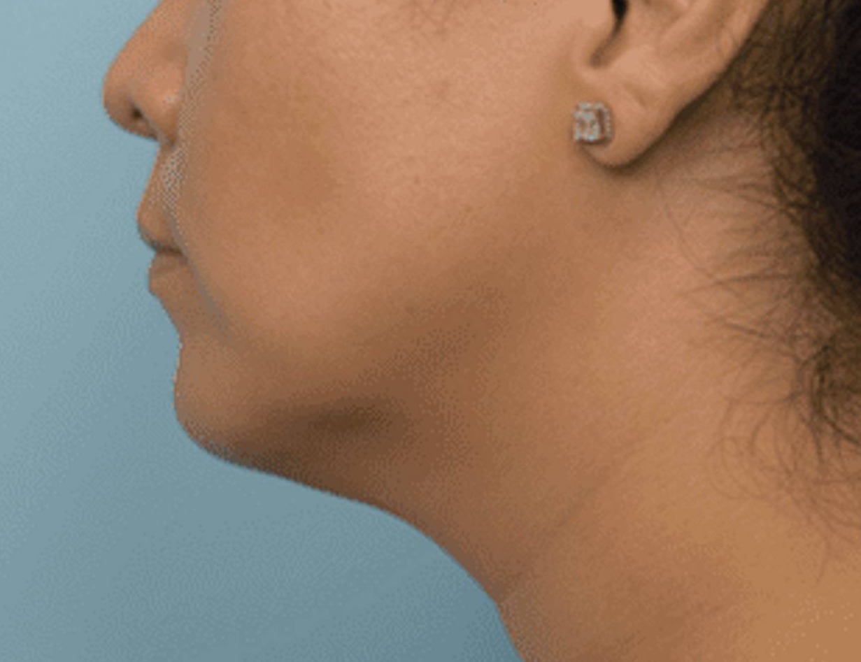 Renuvion Skin Tightening Before & After Image