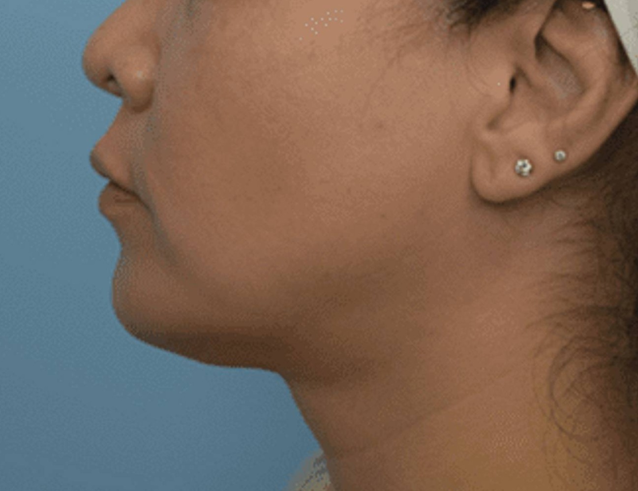 Renuvion Skin Tightening Before & After Image