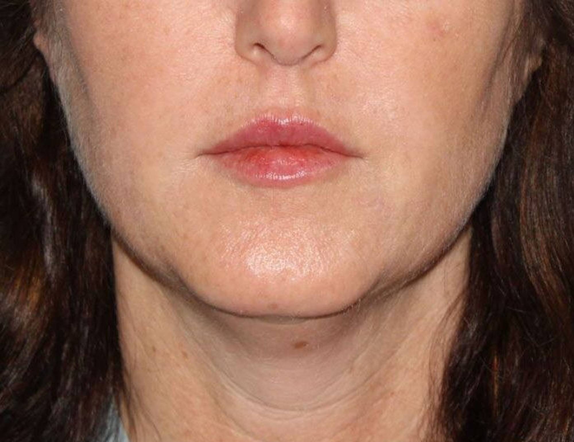 Renuvion Skin Tightening Before & After Image