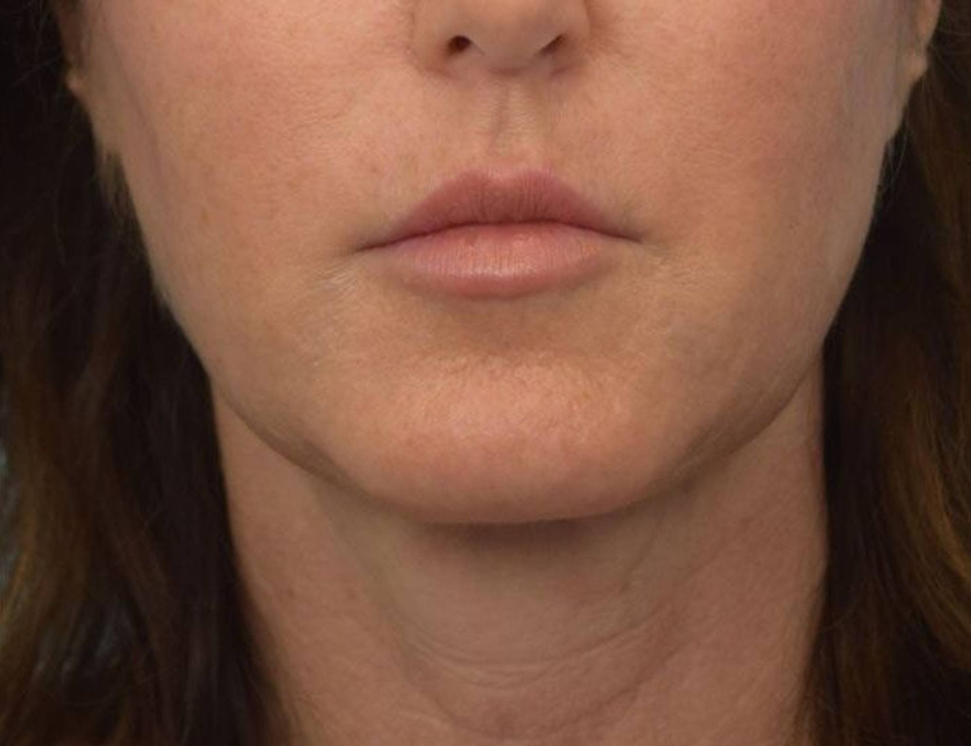 Renuvion Skin Tightening Before & After Image