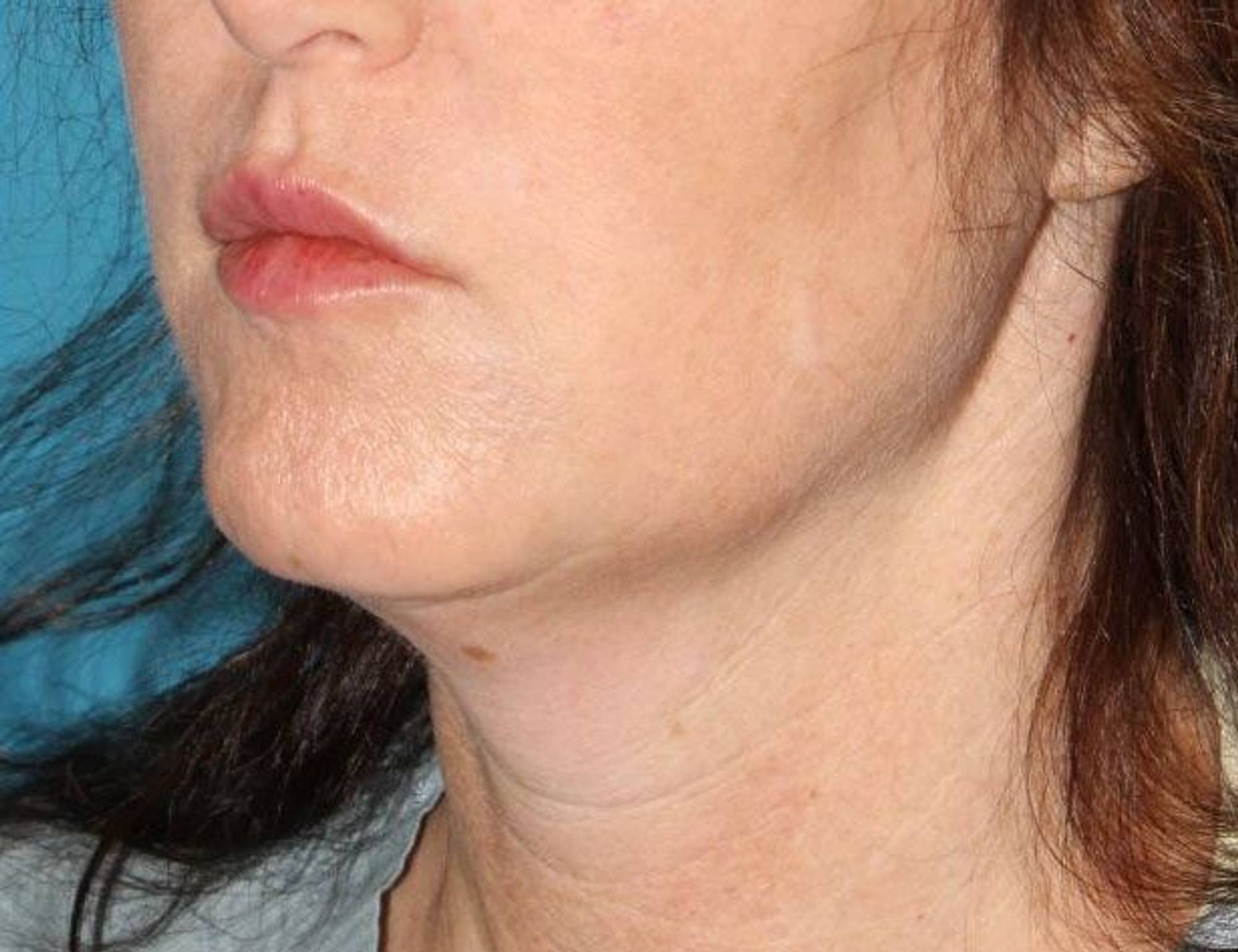 Renuvion Skin Tightening Before & After Image