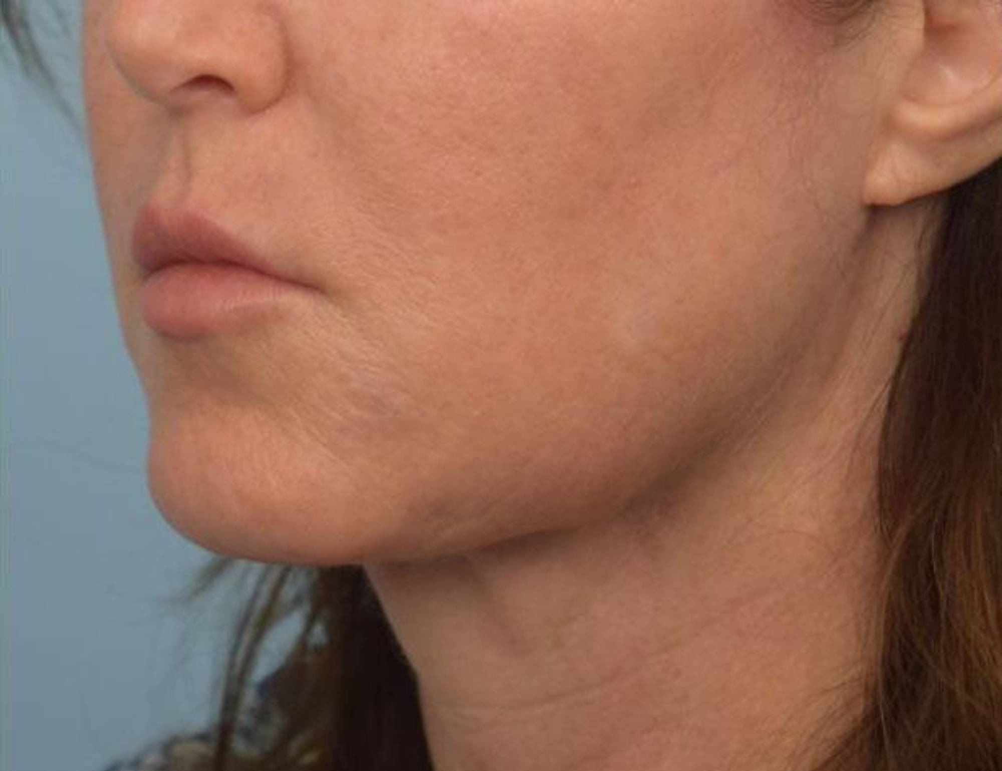 Renuvion Skin Tightening Before & After Image