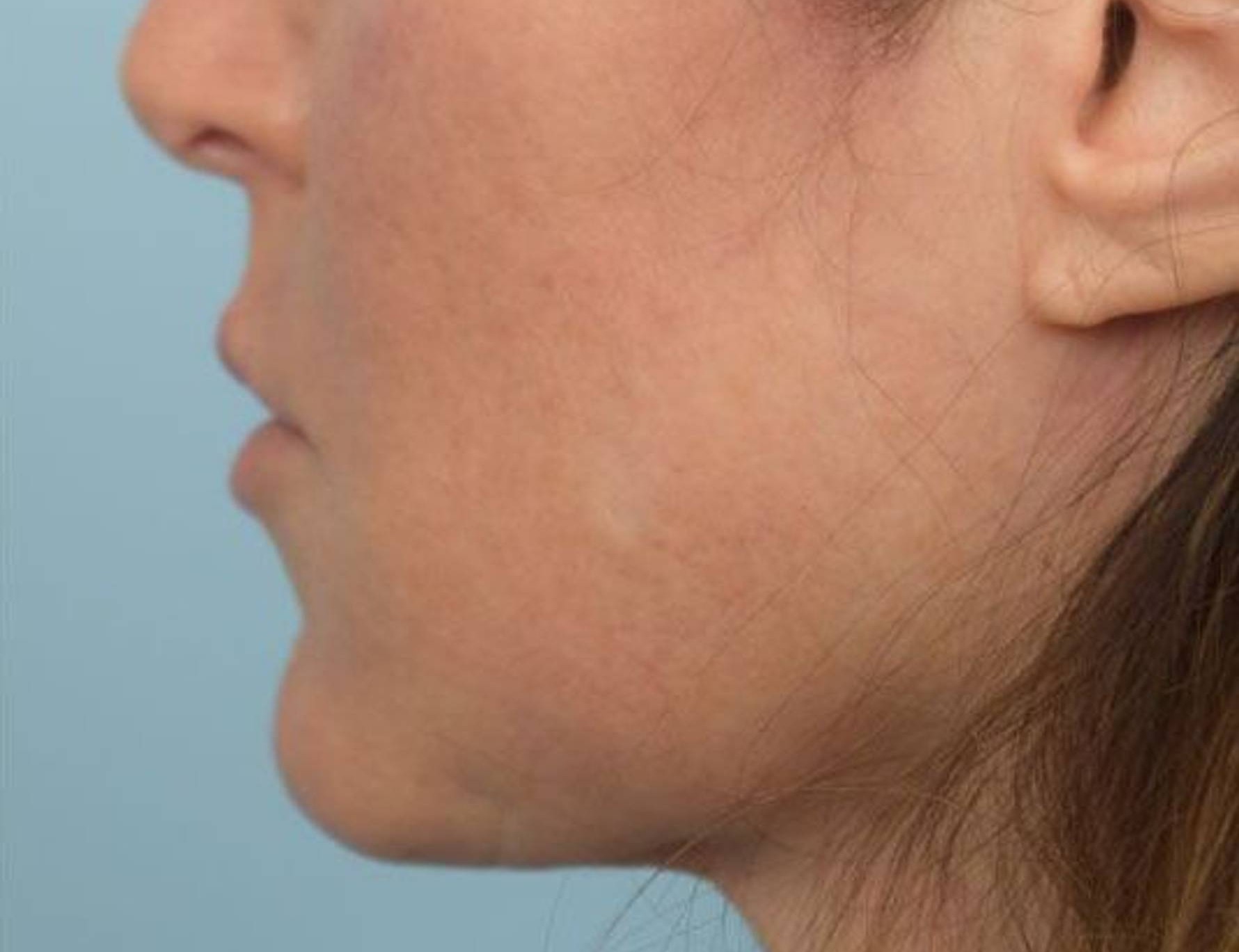 Renuvion Skin Tightening Before & After Image