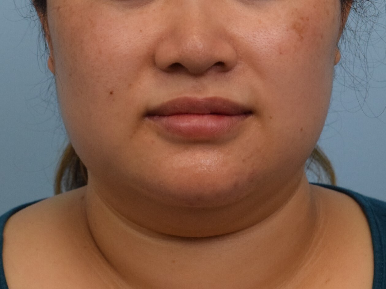 Renuvion Skin Tightening Before & After Image