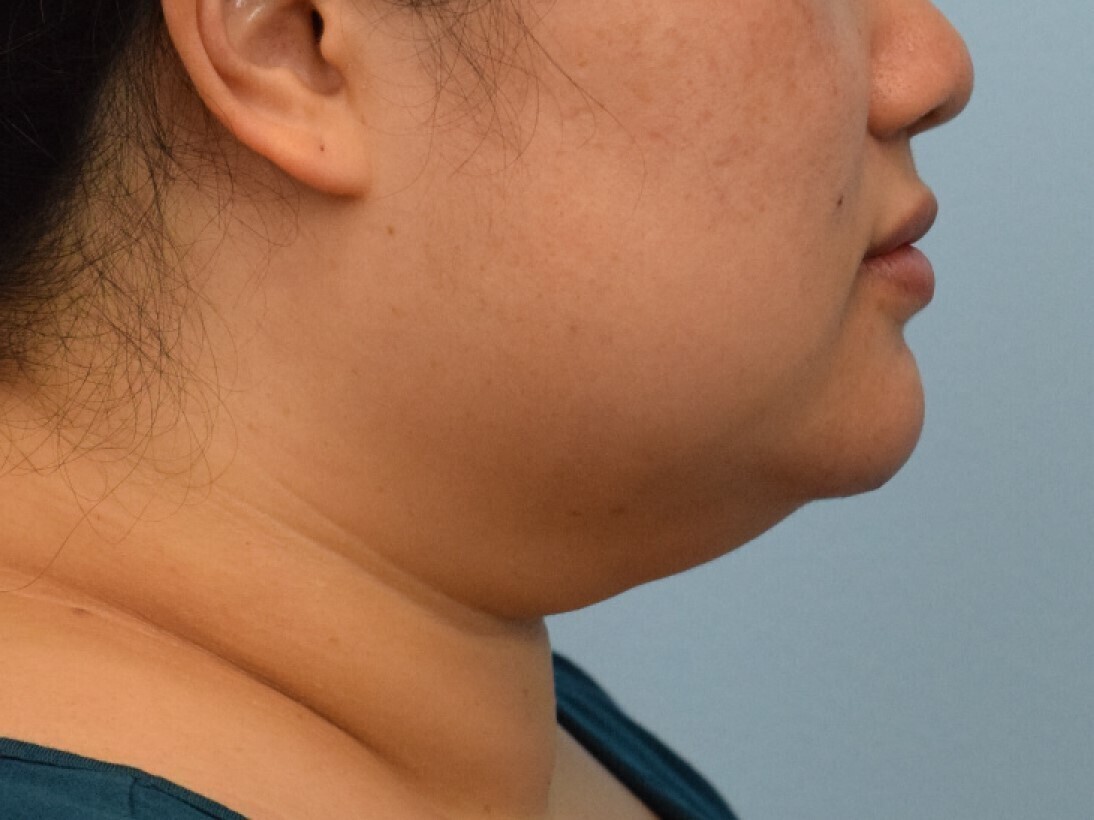 Renuvion Skin Tightening Before & After Image