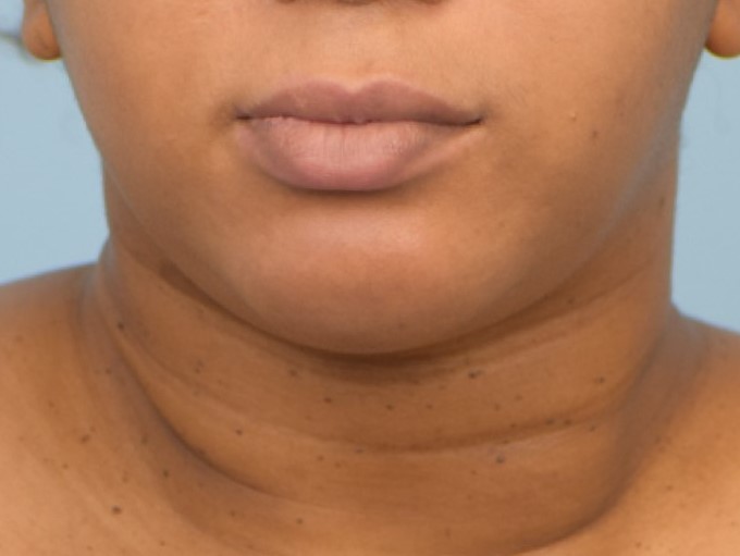 Renuvion Skin Tightening Before & After Image