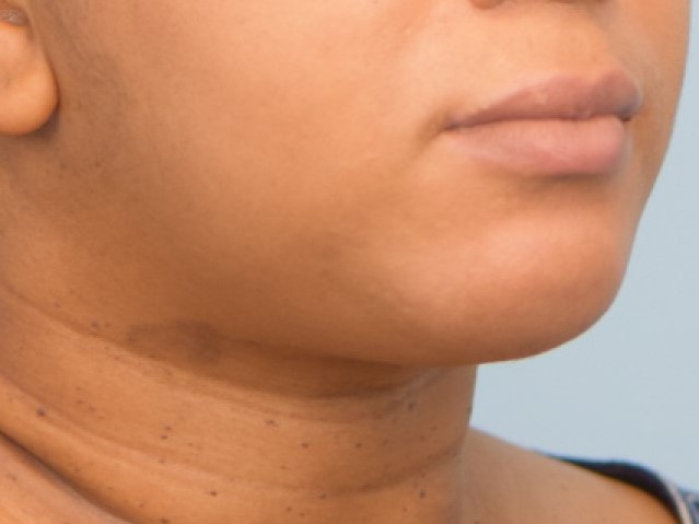 Renuvion Skin Tightening Before & After Image