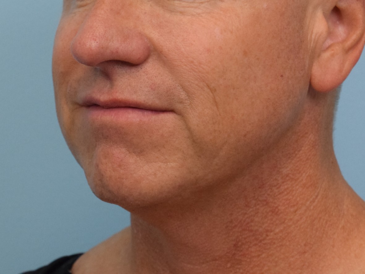 Renuvion Skin Tightening Before & After Image