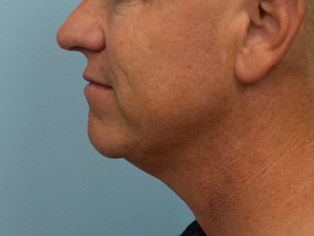 Renuvion Skin Tightening Before & After Image