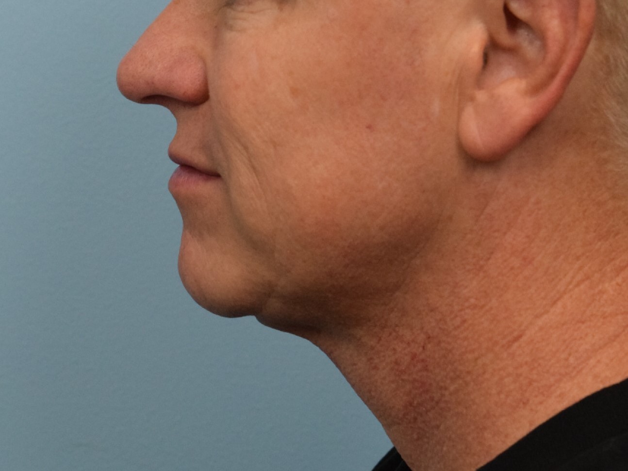 Renuvion Skin Tightening Before & After Image