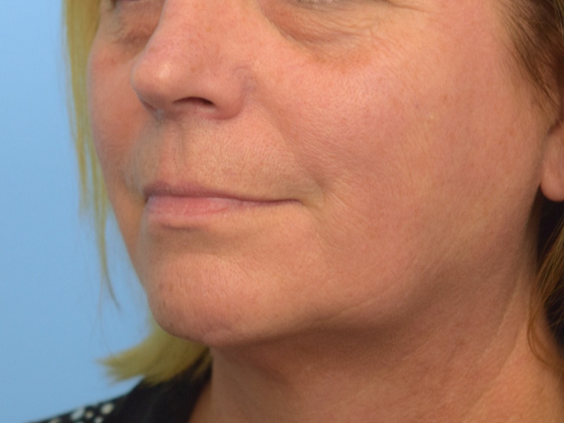 Renuvion Skin Tightening Before & After Image