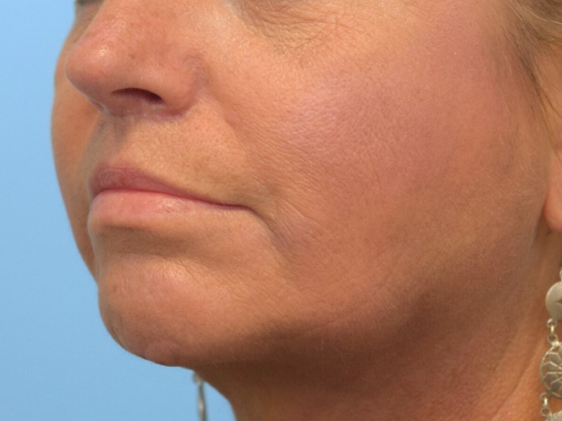 Renuvion Skin Tightening Before & After Image