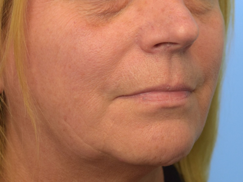 Renuvion Skin Tightening Before & After Image