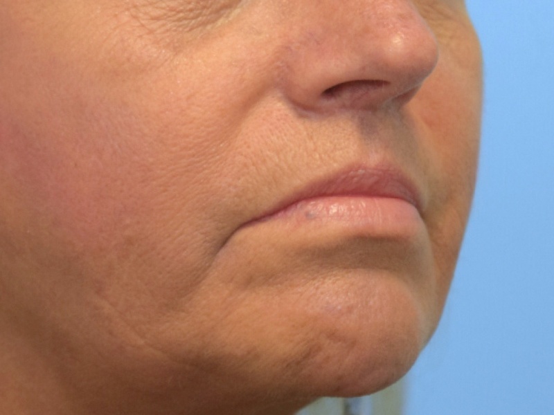 Renuvion Skin Tightening Before & After Image