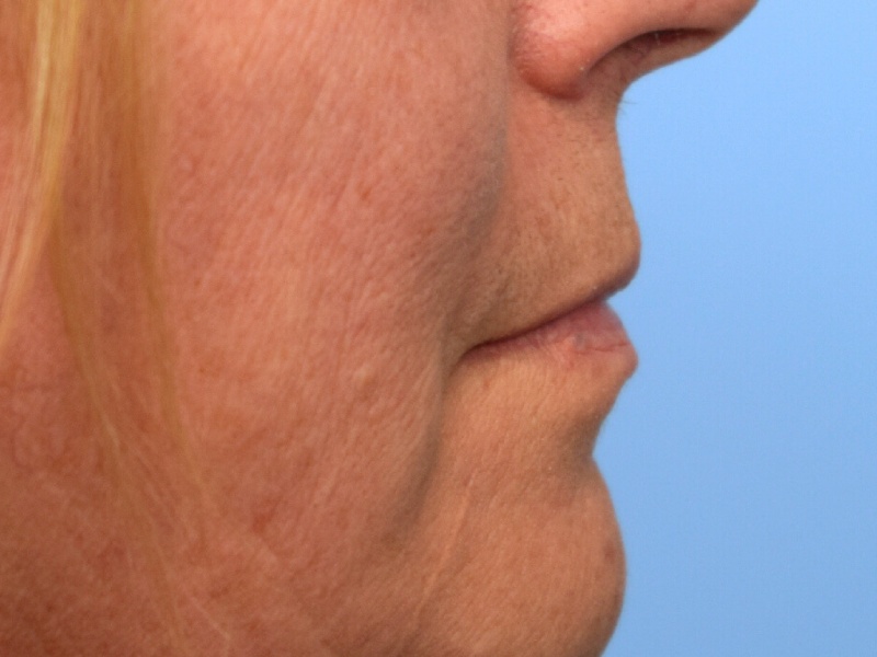 Renuvion Skin Tightening Before & After Image