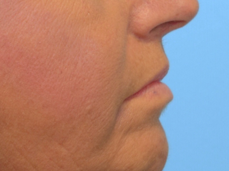 Renuvion Skin Tightening Before & After Image