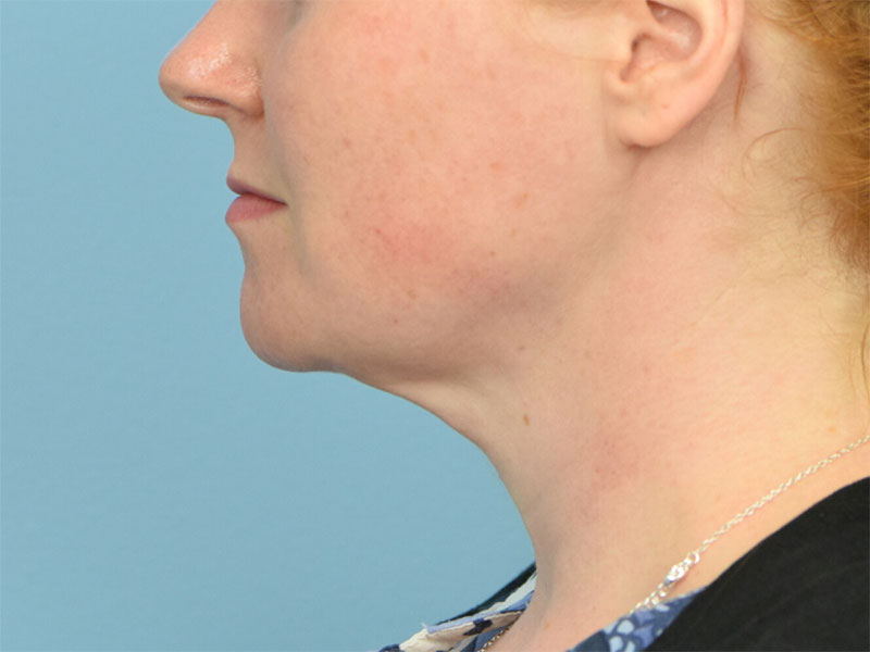 Renuvion Skin Tightening Before & After Image