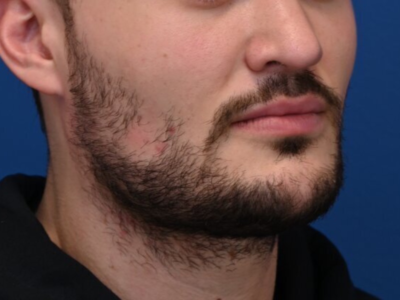 Renuvion Skin Tightening Before & After Image